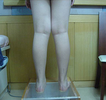 교정장치 착용 전 8.5cm