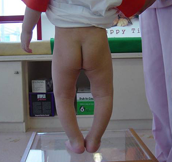 교정장치 착용 전 10cm