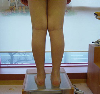 교정장치 3개월 착용 후 3.5cm